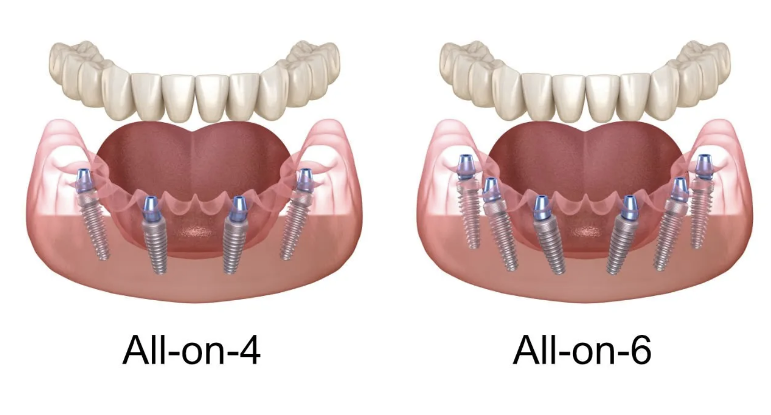 Protezavimas ant implantų